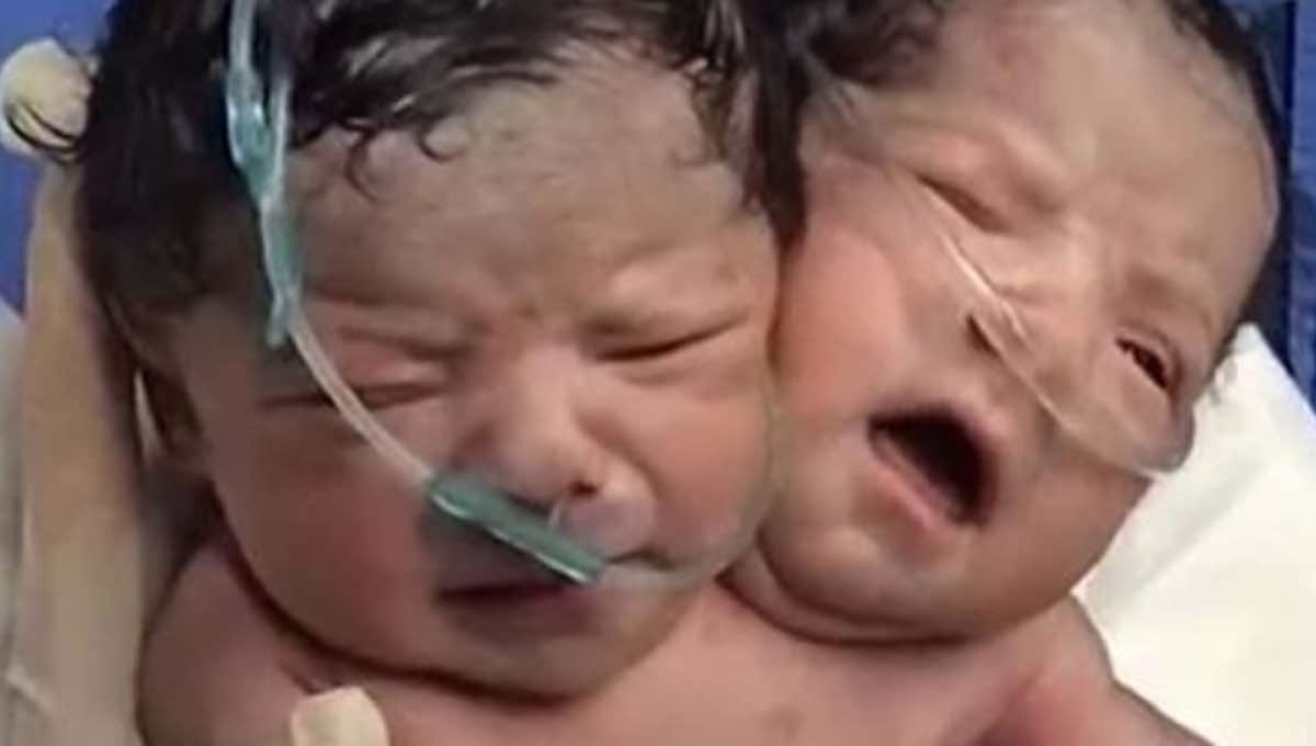 El bebé con dos cabezas que ha conmocionado a México Periodista Digital