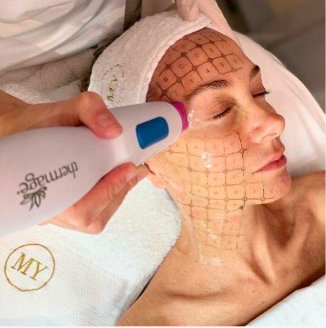 Maribel Yebenes thermage