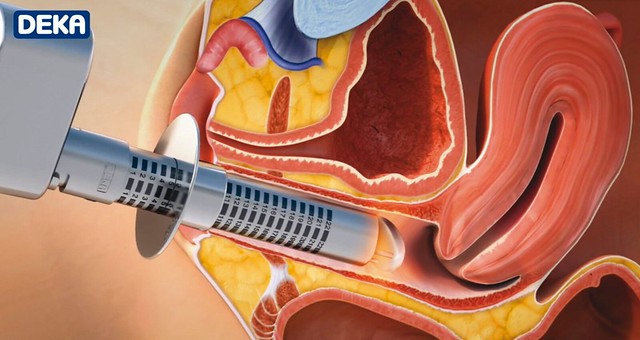 MonaLisa Touch de Deka Láser presentacion