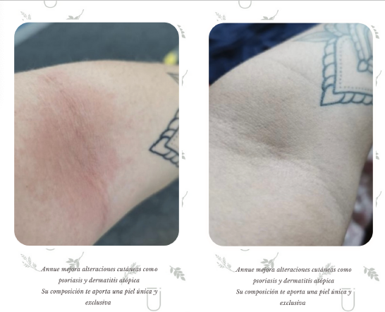 Annue Body elixir dermatitis atopica