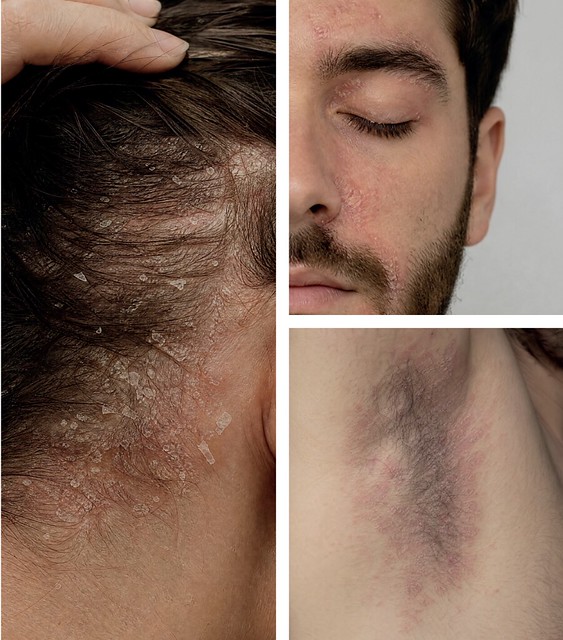 Sensilis dermatitis seborreica