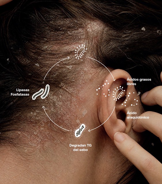 Sensilis dermatitis seborreica