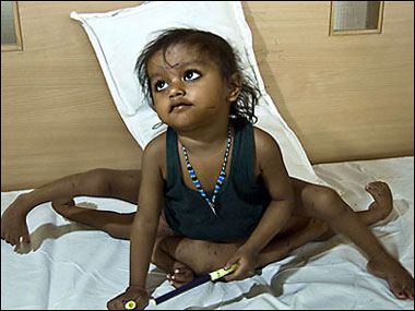 Una niña con ocho extremidades