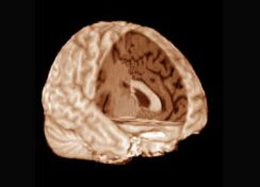 Consumidores de coca&iacute;na tienen la corteza cerebral m&aacute;s delgada