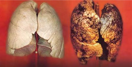 &iexcl;Qu&eacute; miedo de pulmones de fumador!