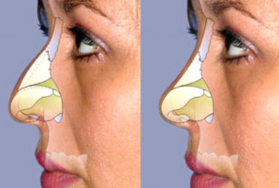 Alerta del aumento de las rinoplastias para reconstrucciones por coca&iacute;na