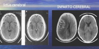 Una de cada diez muertes en Espa&ntilde;a est&aacute; causada por un ictus