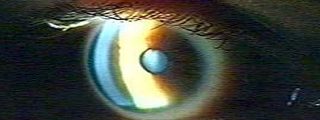 La proinsulina retrasa la p&eacute;rdida de visi&oacute;n