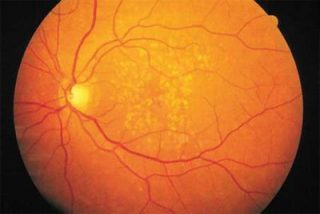 En Espa&ntilde;a se producen 26.000 nuevos casos de ceguera cada a&ntilde;o por degeneraci&oacute;n macular