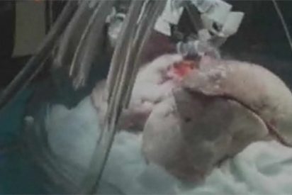 Realizan el primer trasplante de pulm&oacute;n mediante la t&eacute;cnica 'ex vivo'
