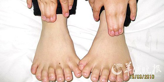 Operan a un ni&ntilde;o chino que naci&oacute; con 14 dedos en las manos y 16 en los pies