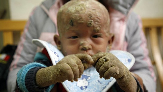 El terrible caso del "ni&ntilde;o pez" que naci&oacute; sin poros en la piel