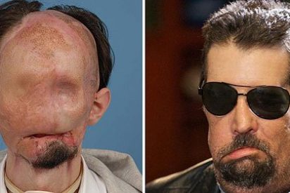 El joven que perdi&oacute; la cara y recibi&oacute; trasplante facial completo, ya puede oler
