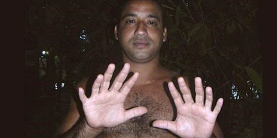 Un joven cubano con 24 dedos asegura que lleva una vida normal