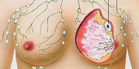 cáncer de mama