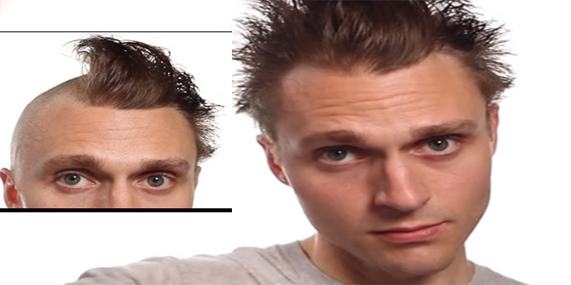 &iquest;Importa la edad a la hora de hacer un injerto capilar?