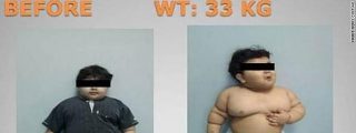 Dejan que su hijo de 2 a&ntilde;os pese 35 kilos y lo 'arreglan' &iexcl;reduci&eacute;ndole el est&oacute;mago!