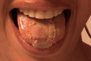 [V&iacute;deo] La joven que quiere ser miss se 'cose' una malla en la lengua para adelgazar