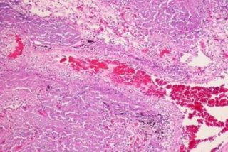 El vinagre mata las micobacterias que producen tuberculosis siendo resistente a los fármacos