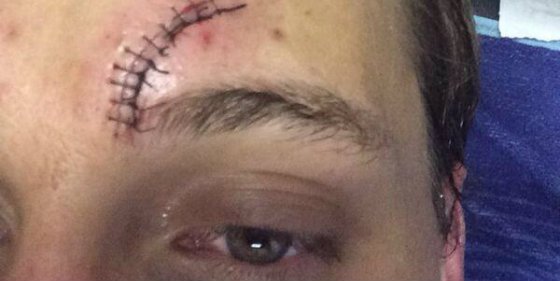 As&iacute; qued&oacute; la cara de Canales tras la brecha