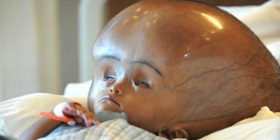 La ni&ntilde;a con el cerebro tres veces m&aacute;s grande de lo normal ya sonr&iacute;e a sus padres