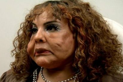 Un falso cirujano le inyect&oacute; cemento en la cara y la dej&oacute; hecha un cromo