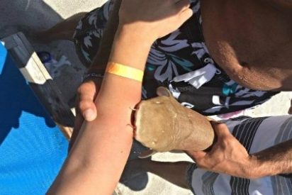 La mujer que ha llegado al hospital con un tibur&oacute;n mordi&eacute;ndole el brazo