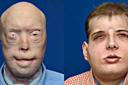 Patrick Hardison: El trasplante de cara más completo de la historia