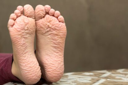 Piel de los pies arrugados