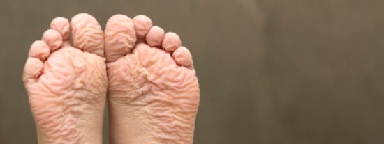 Piel de los pies arrugados