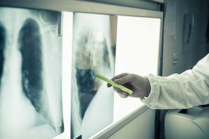 Los c&aacute;nceres de pulm&oacute;n, colorrectal y mama son letales en Espa&ntilde;a