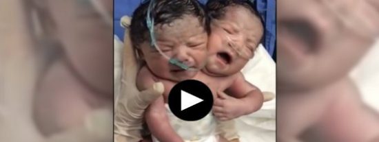 [V&Iacute;DEO] El beb&eacute; con dos cabezas que ha conmocionado a M&eacute;xico