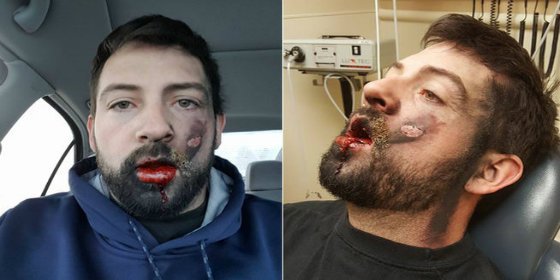Le explota un cigarrillo electr&oacute;nico y se queda con la cara destrozada y sin 7 dientes