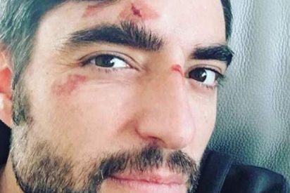 Dani Mateo se inventa un cuento chino para justificar que iba borracho y termin&oacute; con la cara como un mapa