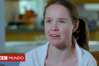 El milagroso caso de la mujer que sobrevive con medio cerebro