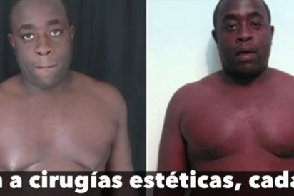 Los hombres tambi&eacute;n se operan los pechos