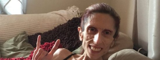 El incre&iacute;ble caso de esta mujer que pesa 20 kilos y sigue viva