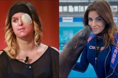La modelo italiana desfigurada con &aacute;cido por su ex novio decidi&oacute; mostrar su rostro
