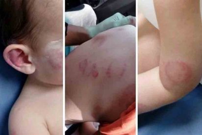 Una madre denuncia a una guarder&iacute;a por devolverle al ni&ntilde;o con 25 mordiscos