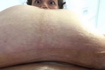 Las impactante fotos de la tripa que le ha quedado tras una ces&aacute;rea