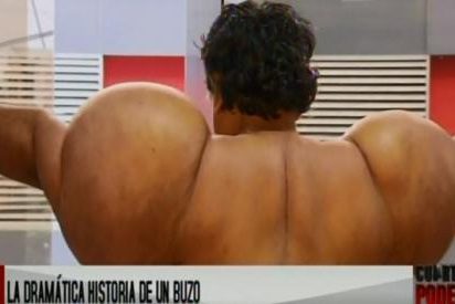 As&iacute; qued&oacute; este buzo deformado por el nitr&oacute;geno