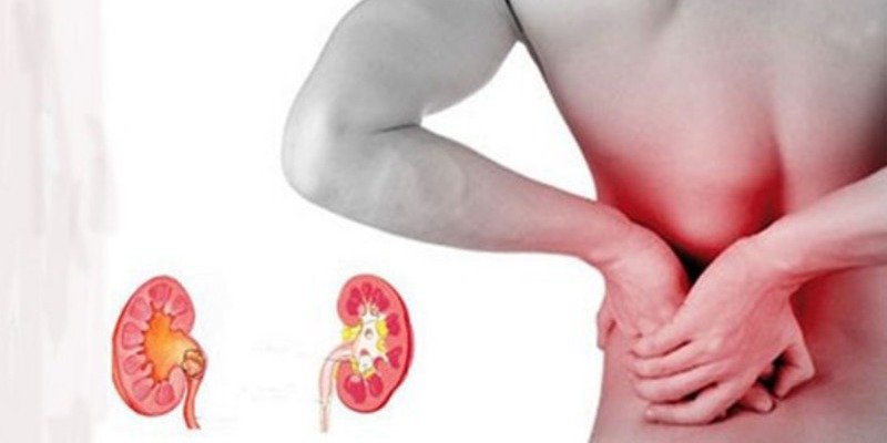 ¿Sabes qué es un cólico nefrítico y sus síntomas?