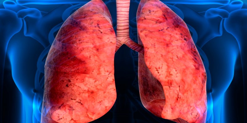 ¿Sabías que unas 7.500 personas en España padecen fibrosis pulmonar idiopática?