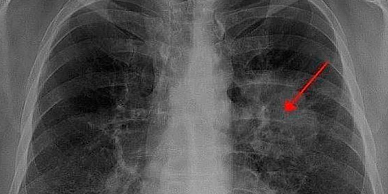 Importante estudio espa&ntilde;ol muestra como revertir el c&aacute;ncer de pulm&oacute;n avanzado en ratones