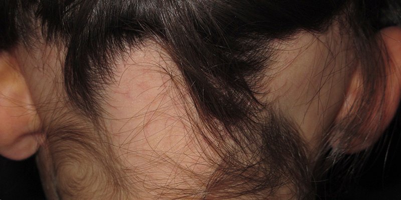 Alopecia areata: causas y s&iacute;ntomas.