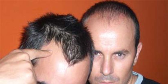 Alopecia difusa: ¿qué es? ¿cómo te afecta?