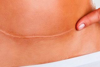 ¿Sabes cuáles son las claves para cuidar una cicatriz de origen quirúrgico?