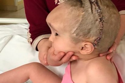 Consiguen reducir en un 50% el tama&ntilde;o del cr&aacute;neo de una ni&ntilde;a de dos a&ntilde;os con hidrocefalia