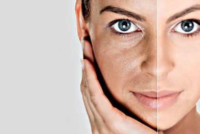 Cirug&iacute;a est&eacute;tica: El rejuvenecimiento facial con IPL