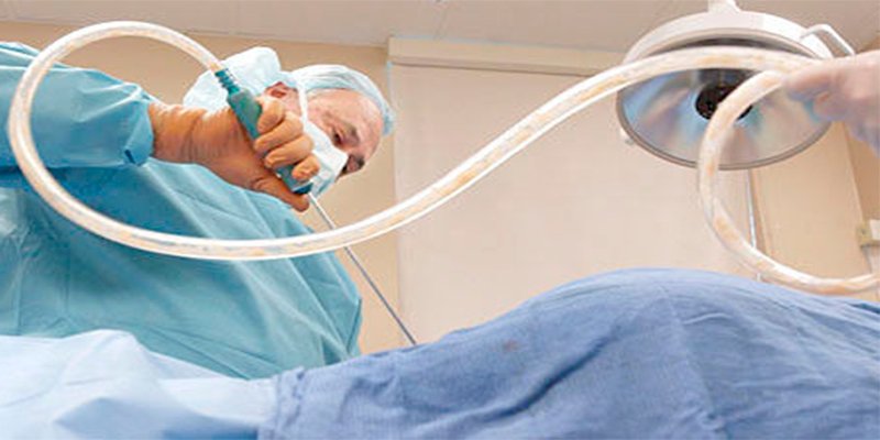 ¿Qué debo esperar de una liposucción?